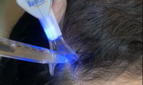 TRATAMENTO DE ALOPECIA - Intradermoterapia